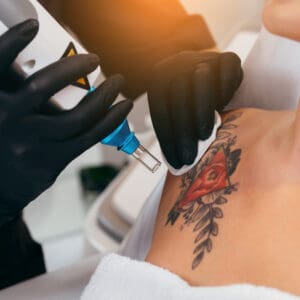 Laser tattoo removal from shoulder