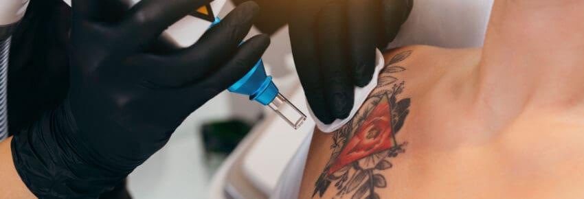 Laser tattoo removal from shoulder