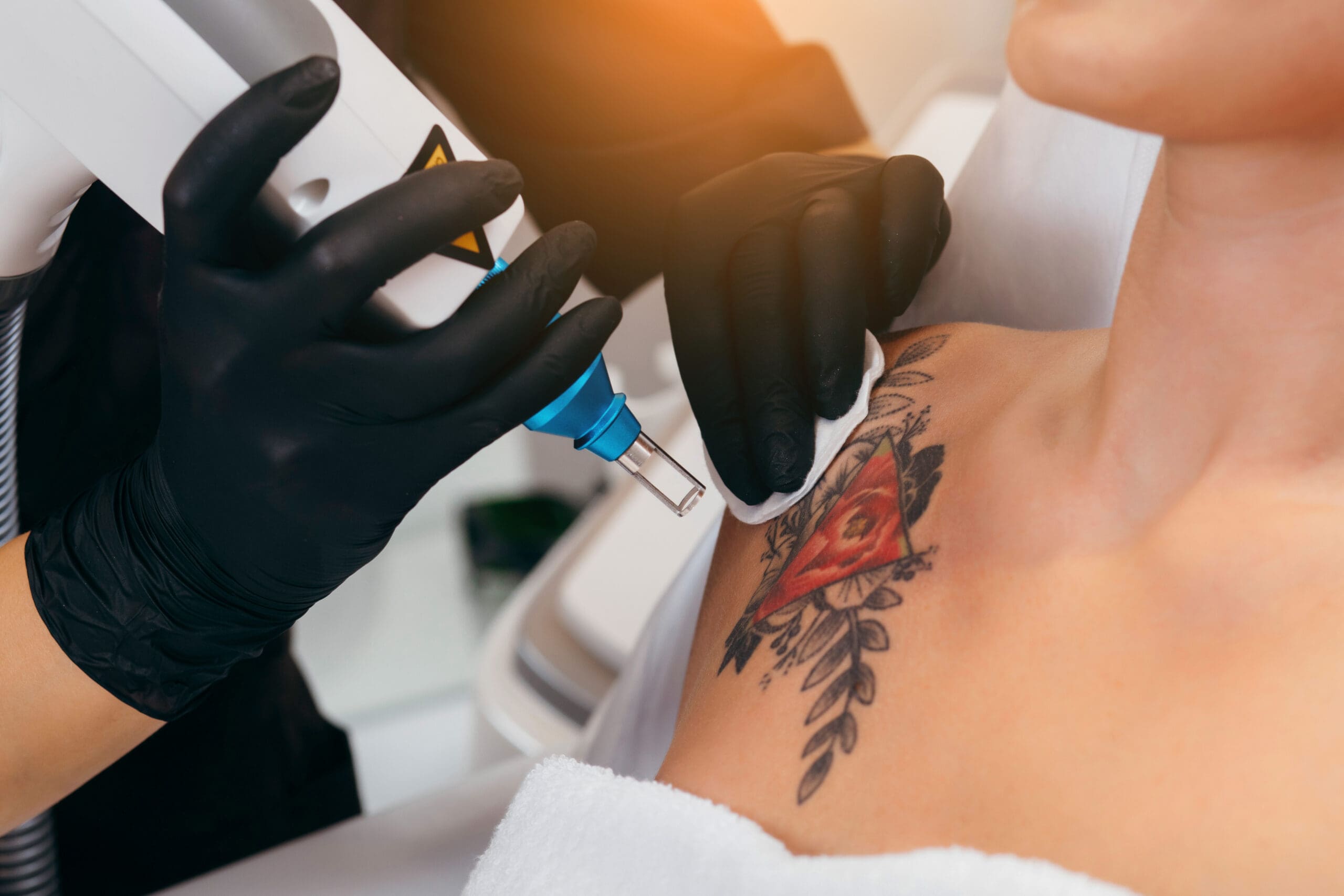 Laser tattoo removal from shoulder