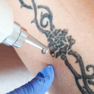 tattoo removal / laser tattoo removal from leg