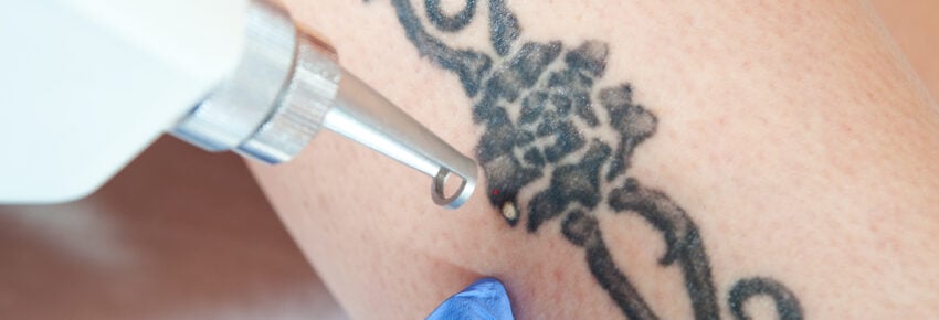 tattoo removal / laser tattoo removal from leg
