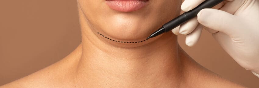 Double chin removal plastic surgery operation concept. Doctor surgeon hands drawing the cut line of female double chin, closeup, cropped