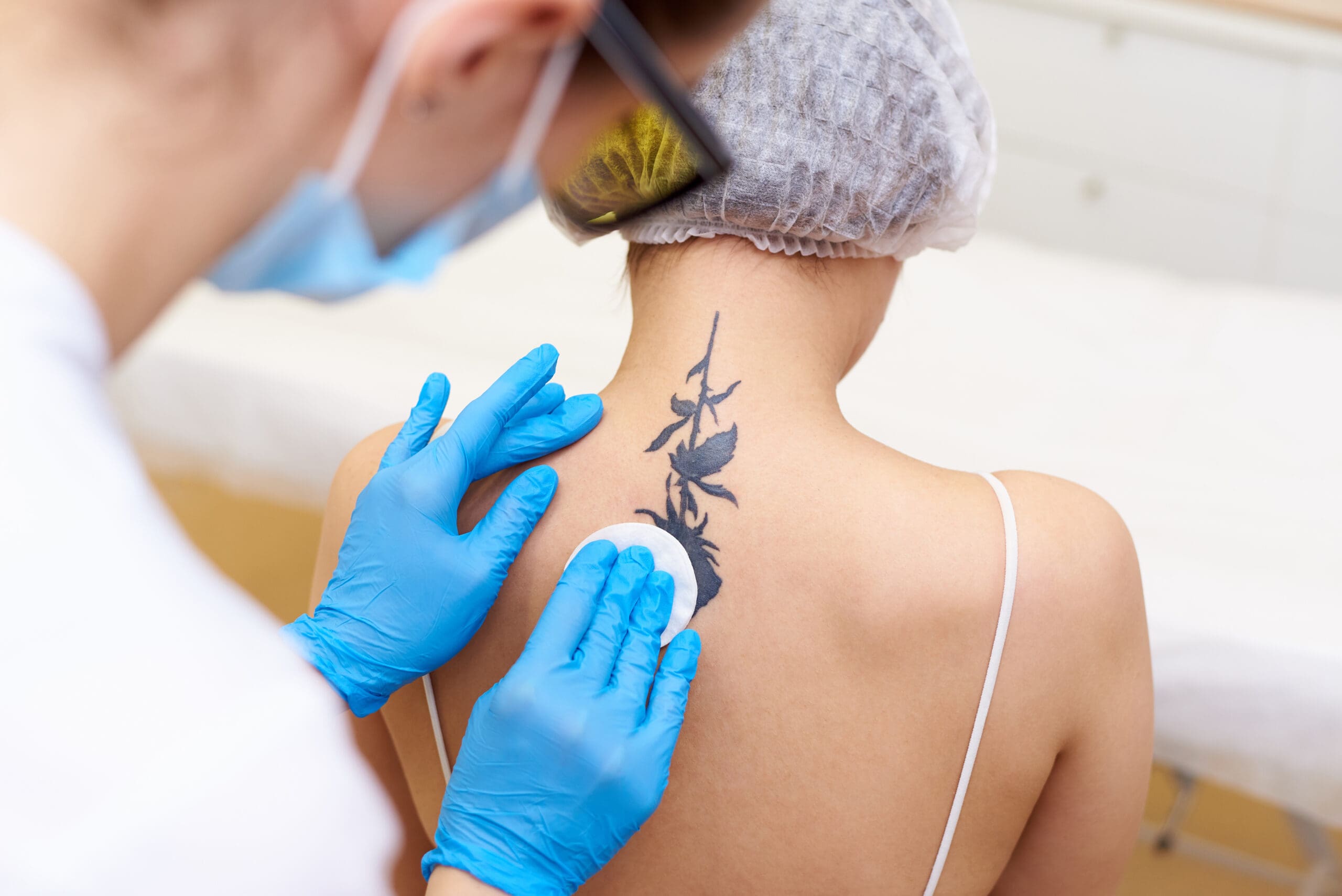 Laser tattoo removal in a cosmetology clinic.