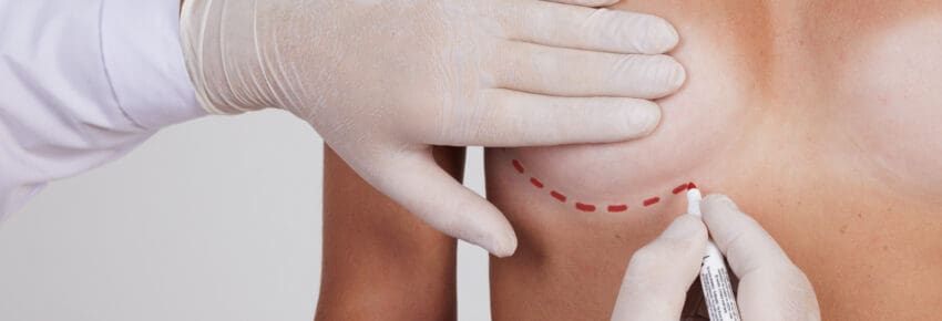 plastic surgeon drawing lines on woman's breast before mammoplasty surgery, breast augmentation