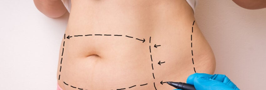 Plastic surgery doctor draw lines with marker on patient belly