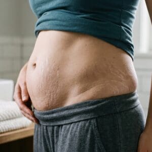 Woman showing stretch marks on belly after pregnancy. Body positive concept regarding postpartum skin changes and motherhood transformation. Female health care and authentic body image.