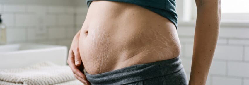 Woman showing stretch marks on belly after pregnancy. Body positive concept regarding postpartum skin changes and motherhood transformation. Female health care and authentic body image.