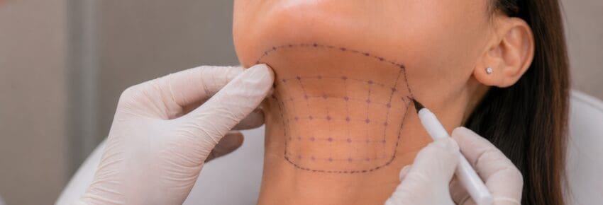 Fat Dissolving Injection Mapping on Female Neck and Chin Area with Purple Grid Markings for Submental Lipolysis Treatment