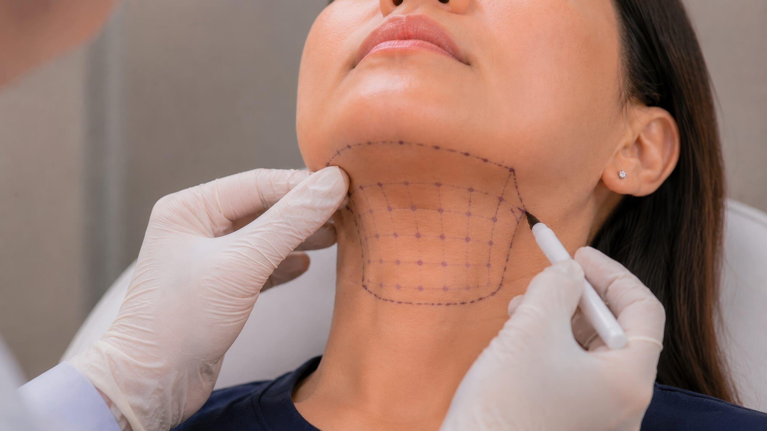 Fat Dissolving Injection Mapping on Female Neck and Chin Area with Purple Grid Markings for Submental Lipolysis Treatment