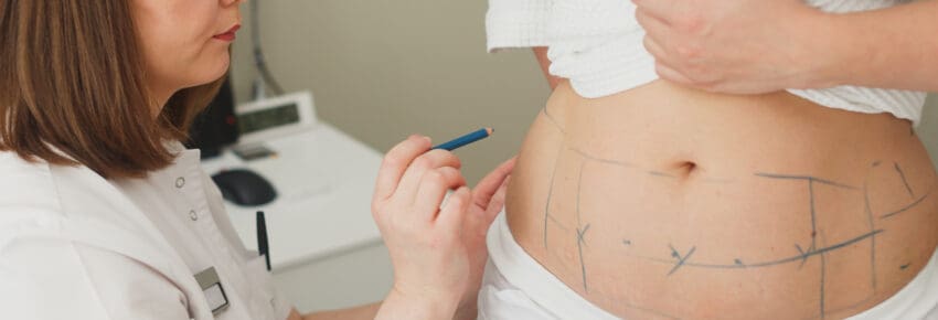 Surgeon, liposuction, body.Overweight, obesity, fat woman, fat belly, hips and excess weight. cellulite, stretching
